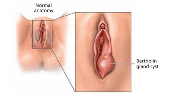 What is a Bartholin cyst and is it dangerous?